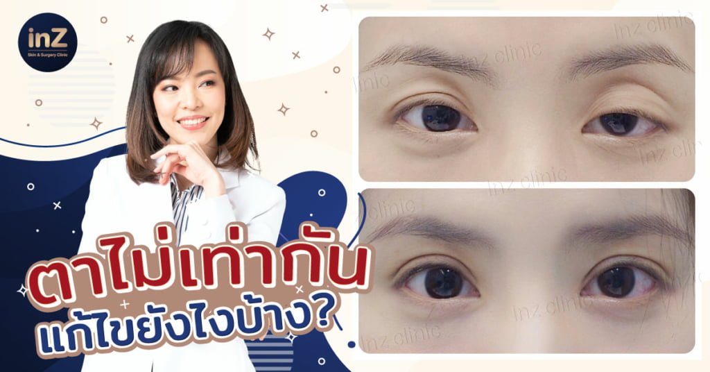 ตาไม่เท่ากัน แก้ไขยังไงได้บ้าง