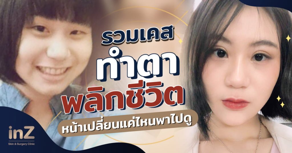 รวมเคสรีวิวทำตาสุดปัง! เพราะดวงตาคือหน้าต่างของหัวใจ
